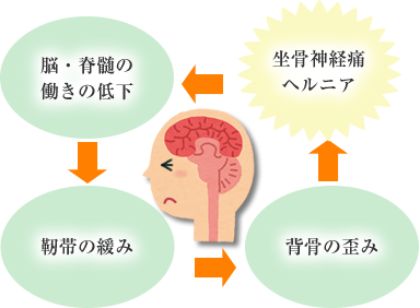 坐骨神経痛・ヘルニアはなぜ起こる